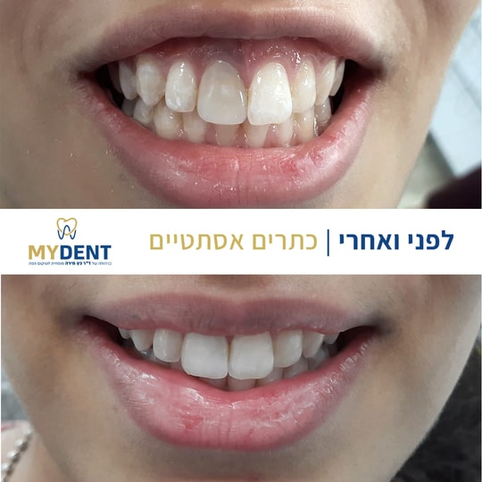 before-after-2-min